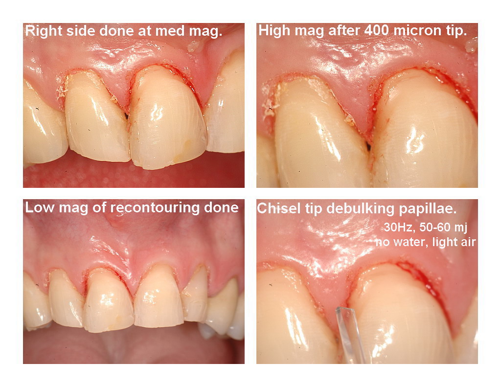 Veneers and recontouring pg3.jpg